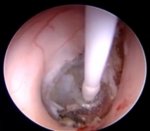 Colloid cyst in the 3rd ventricle - endoscopic excision