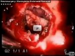 Meningioma Endonasal Removal