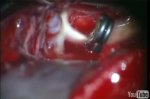 Middle cerebral artery aneurysm