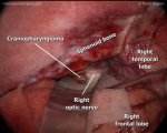 Craniopharyngioma 1