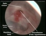Endoscopic 3rd ventriculostomy 1