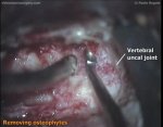 Cervical corpectomy